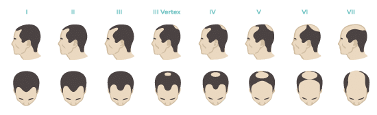 Escala Norwood Escala de Norwood