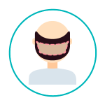 transplante-capilar-1 Identificação das zonas dadoras