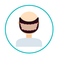 transplante-capilar-1 Identificação das zonas dadoras