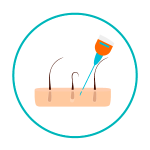 transplante-capilar-2 Aplicação de anestesia local na área dadora