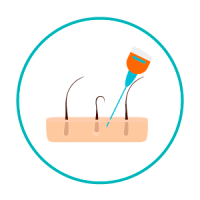 transplante-capilar-2 Aplicação de anestesia local na área dadora