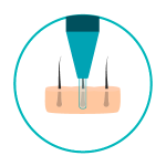 transplante-capilar-3 Pequena incisão ao redor dos folículos saudáveis