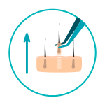 transplante-capilar-4 Extração de unidades foliculares