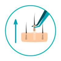 transplante-capilar-4 Extração de unidades foliculares
