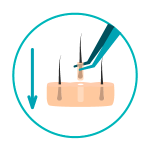 transplante-capilar-6 Implantação das unidades foliculares saudáveis nas zonas recetoras