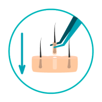 transplante-capilar-6 Implantação das unidades foliculares saudáveis nas zonas recetoras