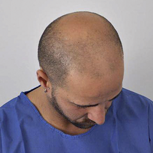 Ricky Andrade - Transplante Capilar