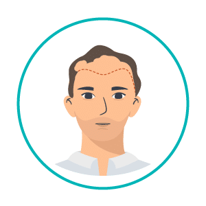 transplante-capilar-icon2 Linha de transplante