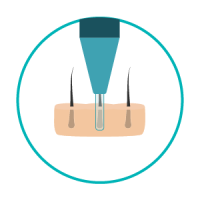 transplante-capilar-icon-incisao-03 Pequena incisão ao redor dos folículos saudáveis