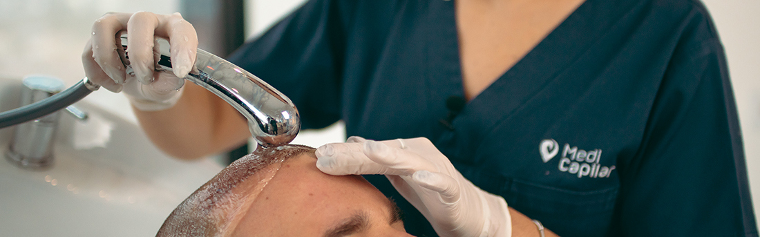 _DSC0403 lavagem3 Lavagem pós Transplante Capilar