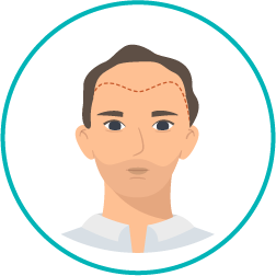 Imagem representativa da segunda fase de como é realizado um transplante capilar – Dia da realização do procedimento cirúrgico. Imagem representativa da segunda fase de como é realizado um transplante capilar – Dia da realização do procedimento cirúrgico.