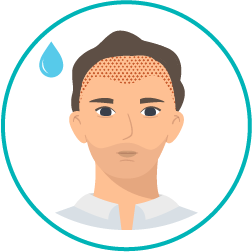 Imagem representativa da terceira fase de como é realizado um transplante capilar – Lavagem da cabeça Imagem representativa da terceira fase de como é realizado um transplante capilar – Lavagem da cabeça