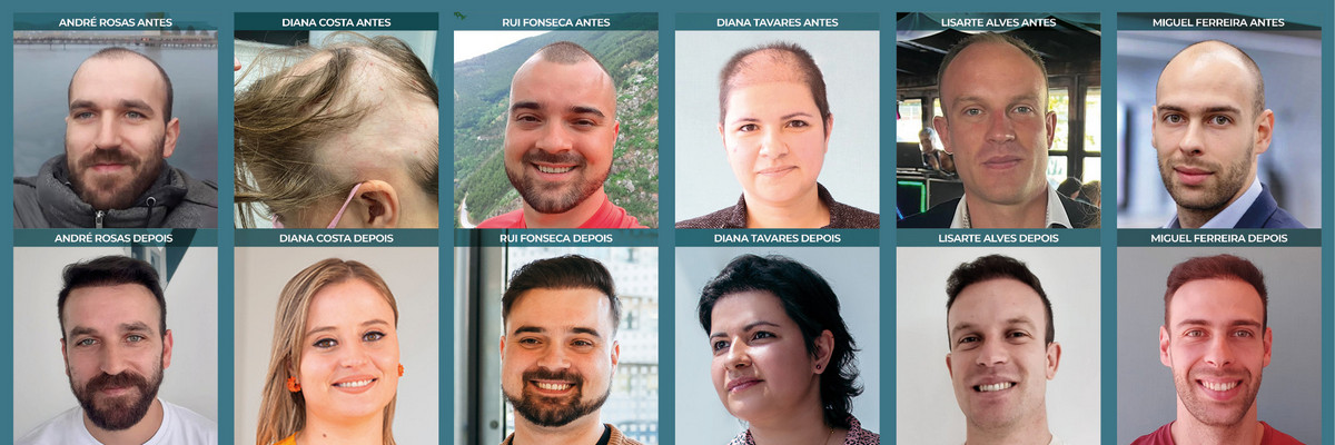 Casos de sucesso de pacientes que realizaram os seus tratamentos ou transplantes capilar na Clínica MediCapilar Casos de sucesso de pacientes que realizaram os seus tratamentos ou transplantes capilar na Clínica MediCapilar